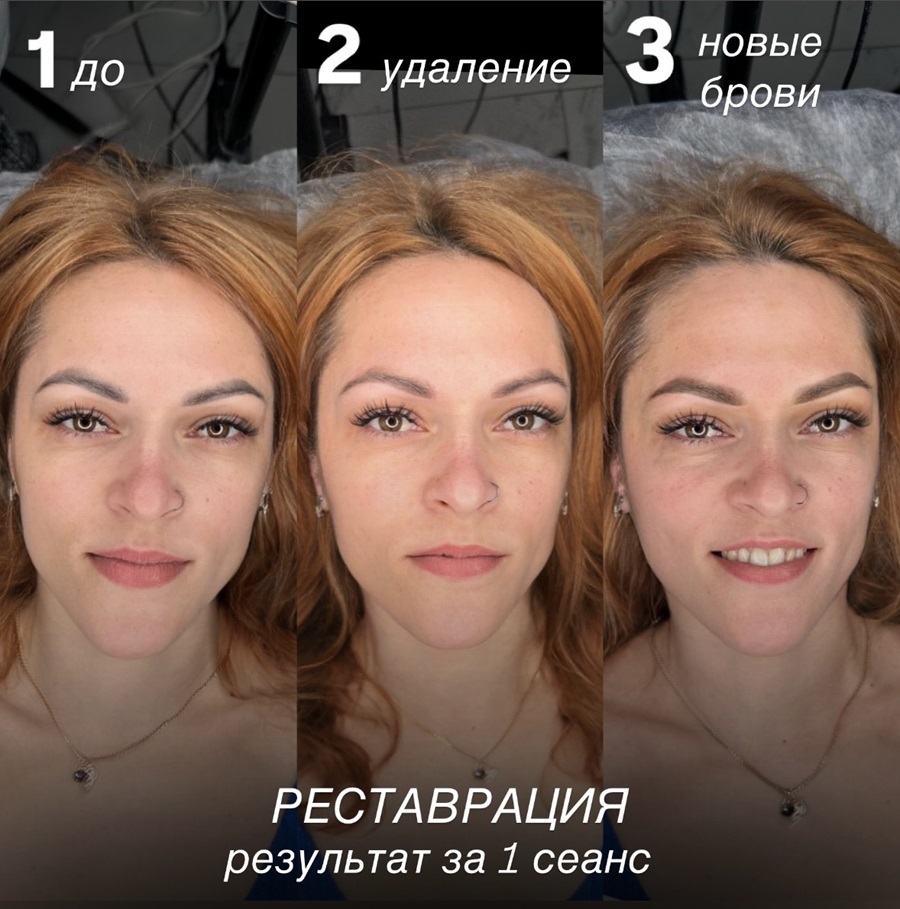 Реставрация бровей: до → удаление → новые брови за 1 сеанс